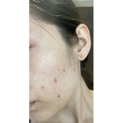 Mizon Сыворотка против акне Acence Blemish Spot Solution Serum (30 мл)